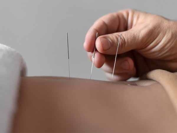 Akupunktur Ankara